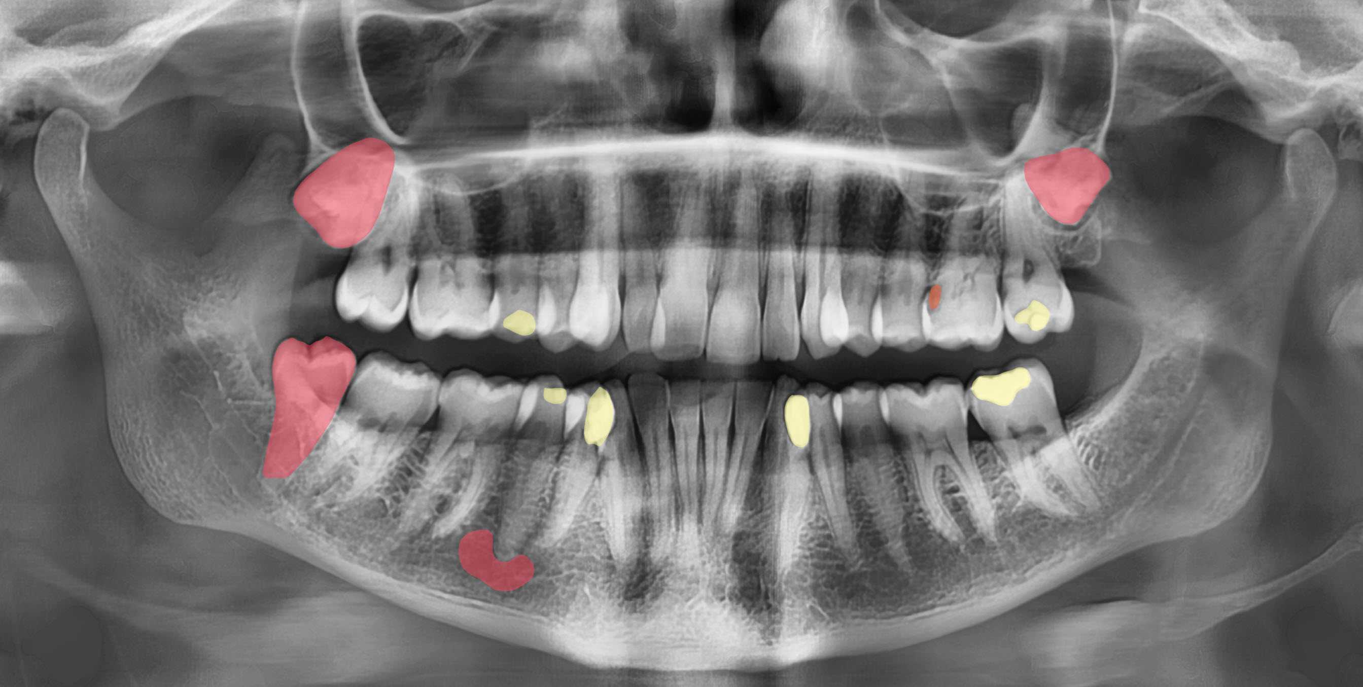 AI Radiology reports