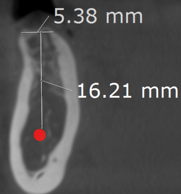 Implant bone measurements CBCT